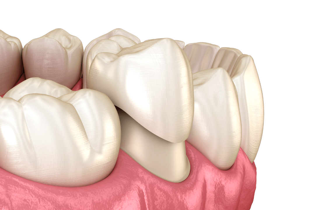 Dental Crowns
