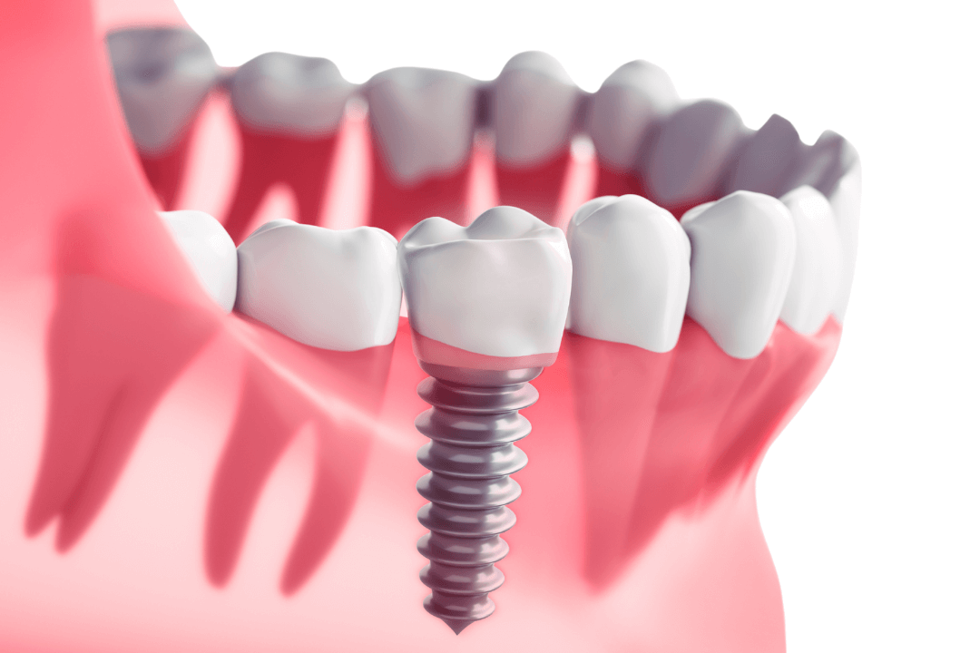 Dental Implants
