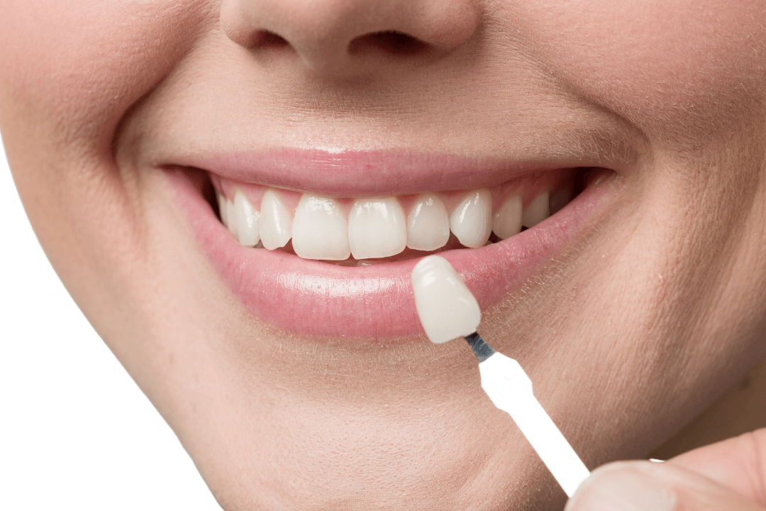 Dental Veneers